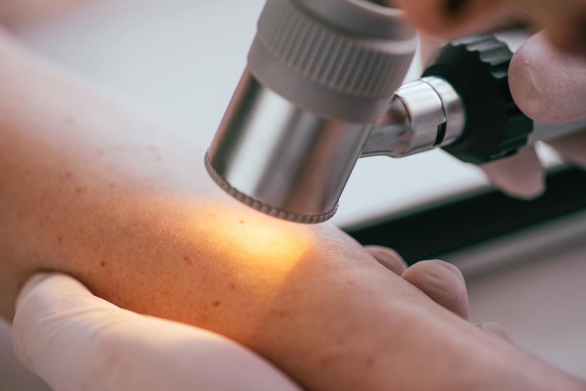 Bőrgyógyászati elváltozások vizsgálata dermatoszkóppal