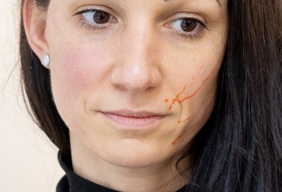 Szál behúzás - Esztétikai kezelés FACE LIFTING műtét nélkül.