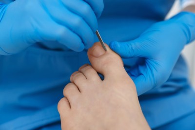 Benőtt köröm kezelése otthon - Csak enyhébb esetekben javasolt