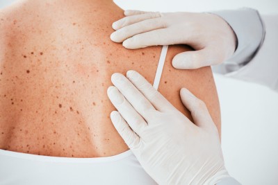 Gyakori bőrelváltozások és okaik - Minden, amit tudni kell, egy helyen